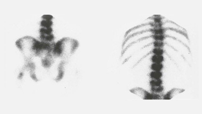 Technetium-99m (99mTc) is a generator-produced isotope that is readily available and has a number of advantages over 201Tl for gamma camera imaging.